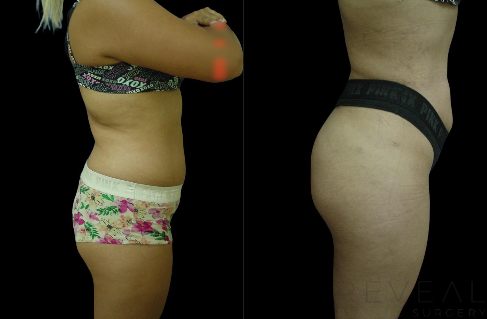 Before & After Brazilian Butt Lift Case 630 Right Side View in San Jose, CA