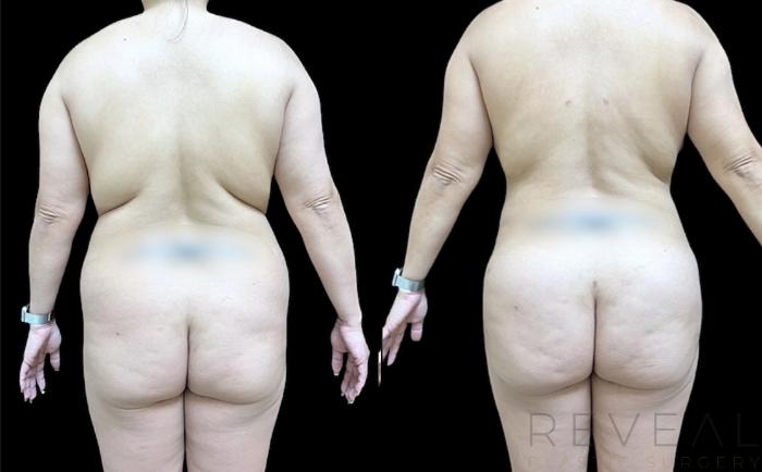 Before & After Brazilian Butt Lift Case 657 Back View in San Jose, CA