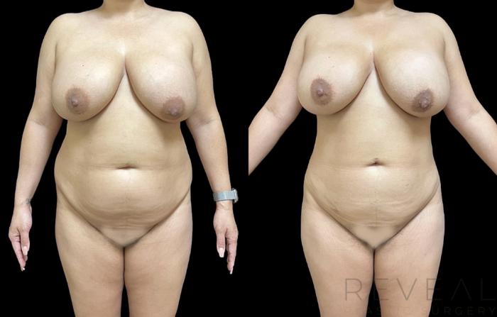 Before & After Brazilian Butt Lift Case 657 Front View in San Jose, CA