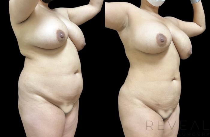 Before & After Mommy Makeover Case 657 Left Side View in San Jose, CA