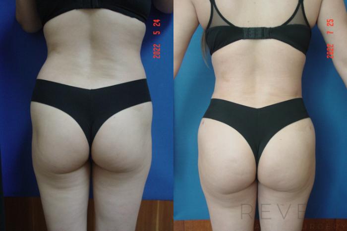 Before & After Brazilian Butt Lift Case 662 Back View in San Jose, CA