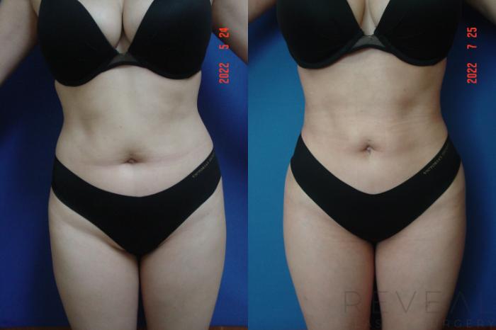 Before & After Brazilian Butt Lift Case 662 Front View in San Jose, CA