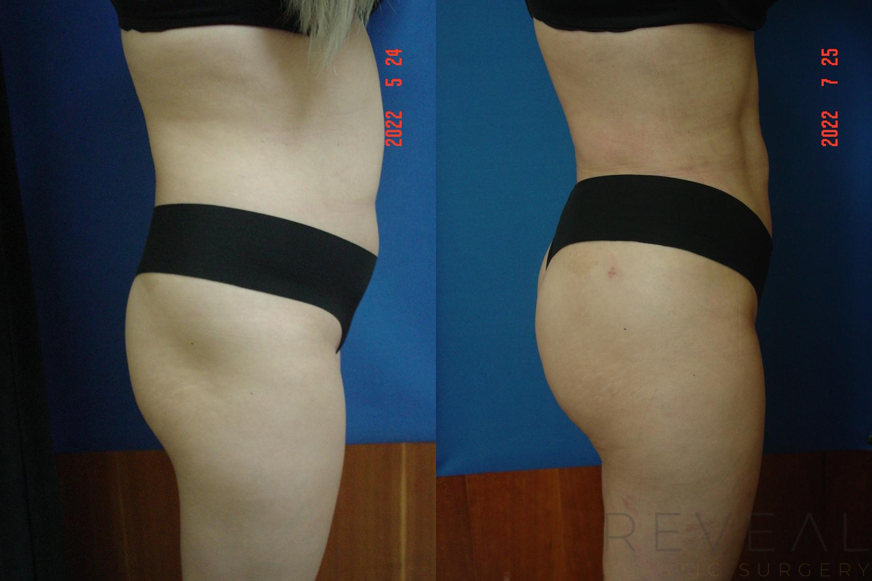Before & After Brazilian Butt Lift Case 662 Left Side View in San Jose, CA