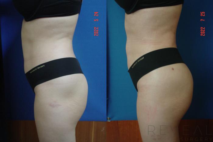 Before & After Brazilian Butt Lift Case 662 Right Side View in San Jose, CA
