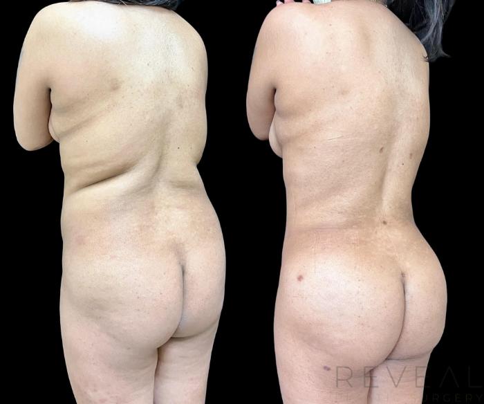 Before & After Brazilian Butt Lift Case 663 Back Right View in San Jose, CA