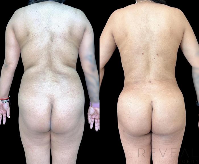 Before & After Brazilian Butt Lift Case 663 Back View in San Jose, CA