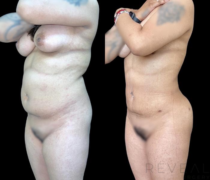 Before & After Brazilian Butt Lift Case 663 Left Side View in San Jose, CA