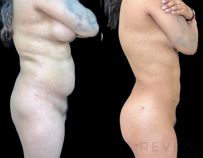 Before & After Brazilian Butt Lift Case 663 Right Side View in San Jose, CA