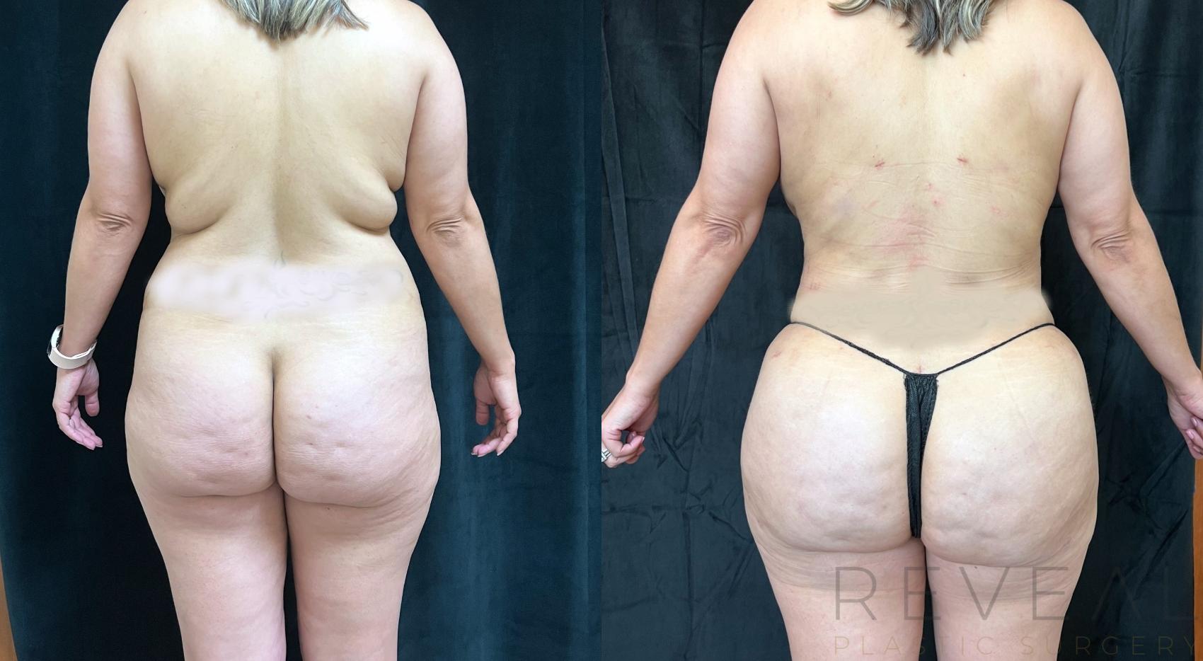 Before & After Brazilian Butt Lift Case 665 Back View in San Jose, CA