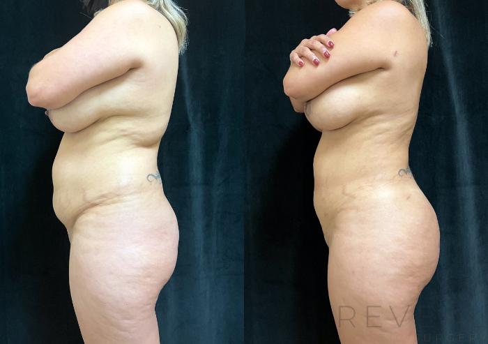 Before & After Brazilian Butt Lift Case 665 Left Oblique View in San Jose, CA