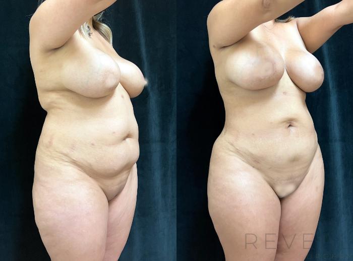 Before & After Brazilian Butt Lift Case 665 Left Side View in San Jose, CA