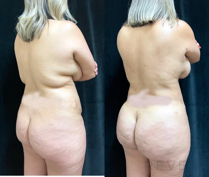 Before & After Brazilian Butt Lift Case 665 Right Oblique View in San Jose, CA