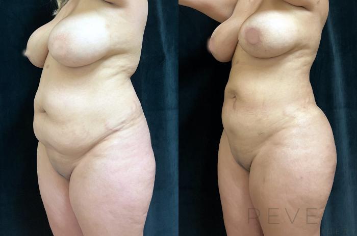 Before & After Brazilian Butt Lift Case 665 Right Side View in San Jose, CA