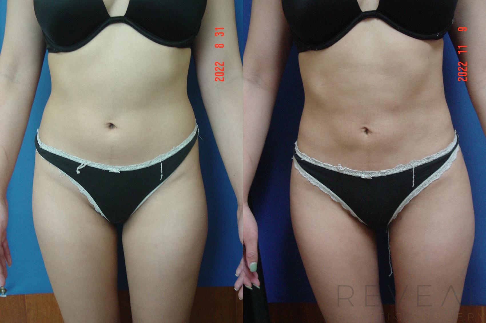 Before & After Brazilian Butt Lift Case 707 Front View in San Jose, CA