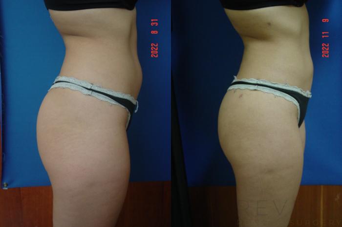 Before & After Brazilian Butt Lift Case 707 Left Side View in San Jose, CA