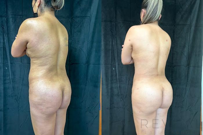 Before & After Liposuction Case 746 Right Side View in San Jose, CA