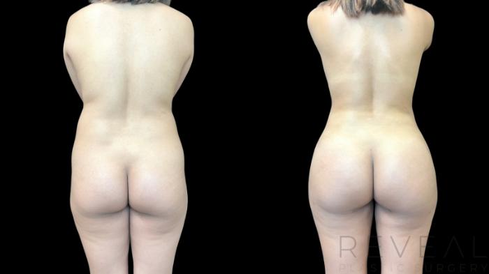 Before & After Liposuction Case 779 Back 2 View in San Jose, CA