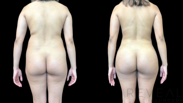 Before & After Liposuction Case 779 Back View in San Jose, CA