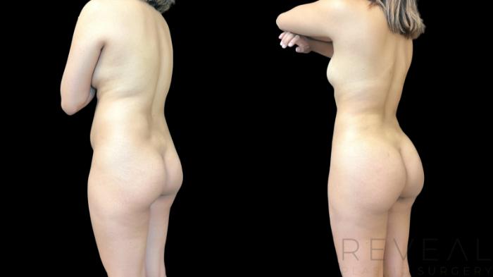 Before & After Brazilian Butt Lift Case 779 Left Oblique View in San Jose, CA