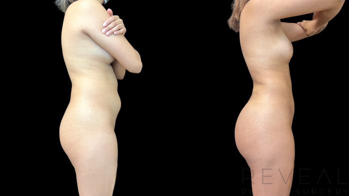 Before & After Liposuction Case 779 Right Side View in San Jose, CA