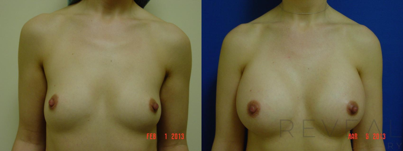 Before & After Breast Augmentation Case 105 View #1 View in San Jose, CA