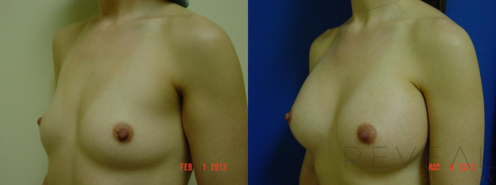 Before & After Breast Augmentation Case 105 View #2 View in San Jose, CA