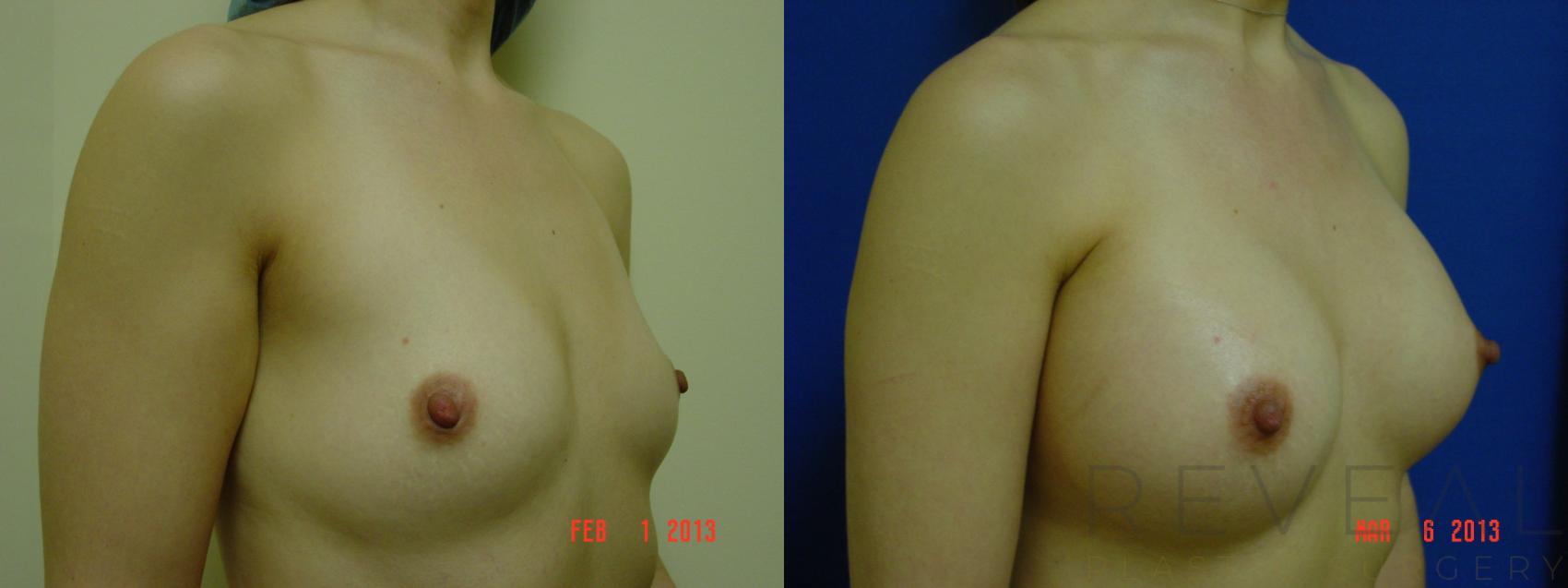 Before & After Breast Augmentation Case 105 View #3 View in San Jose, CA