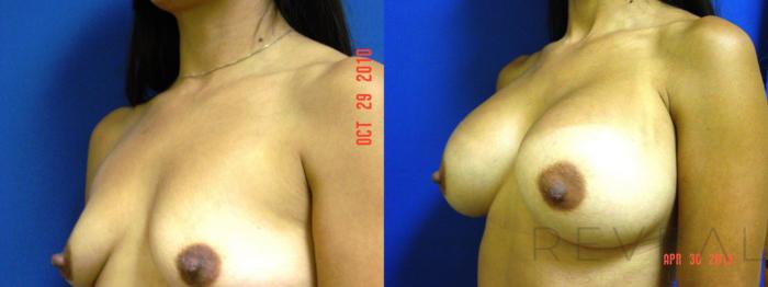 Before & After Breast Augmentation Case 110 View #2 View in San Jose, CA