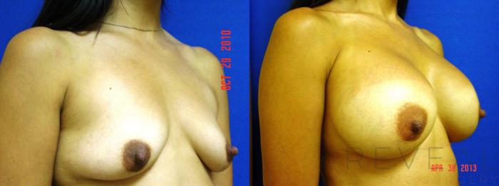 Before & After Breast Augmentation Case 110 View #3 View in San Jose, CA
