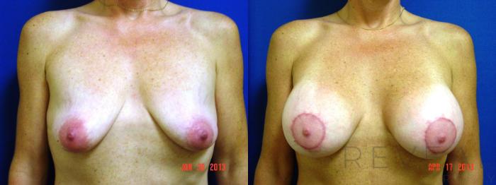 Before & After Breast Lift Case 111 View #1 View in San Jose, CA