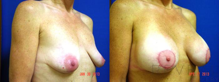 Before & After Breast Lift Case 111 View #2 View in San Jose, CA