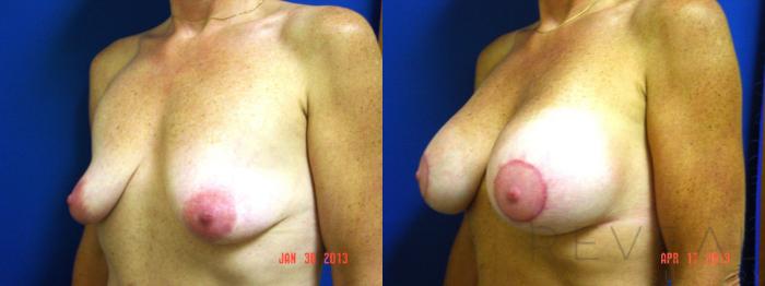 Before & After Breast Augmentation Case 111 View #3 View in San Jose, CA