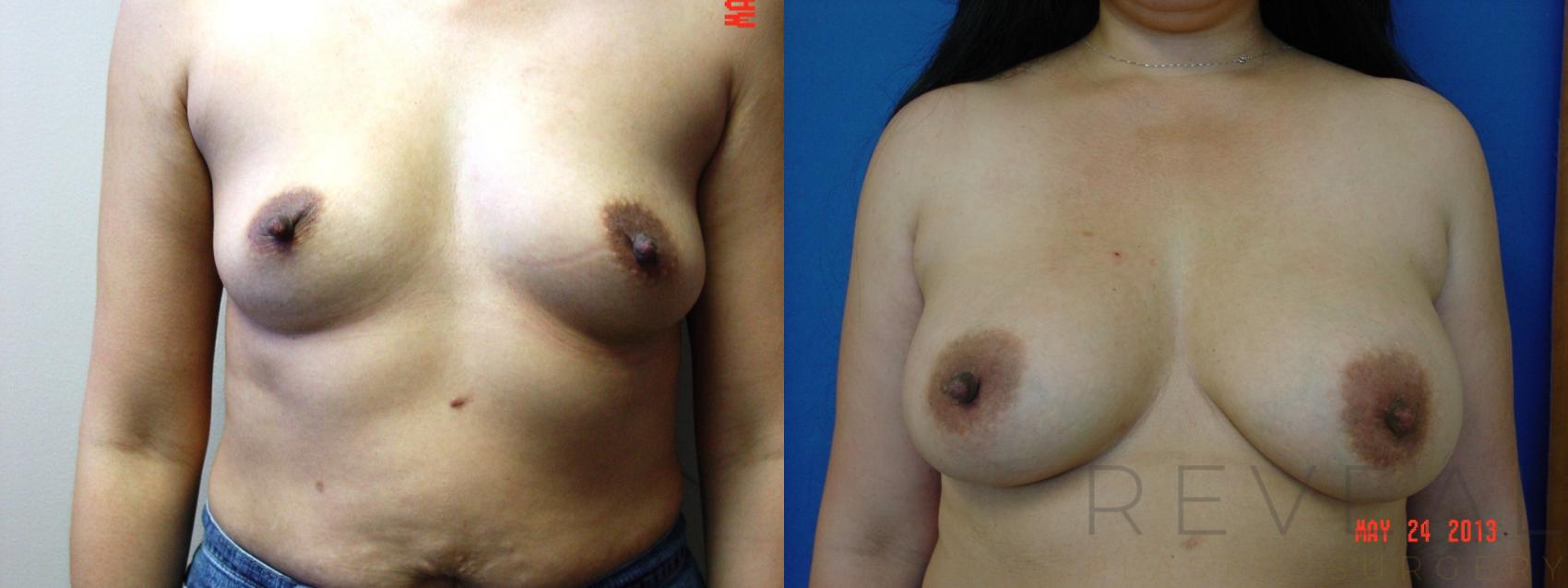 Before & After Breast Augmentation Case 112 View #1 View in San Jose, CA