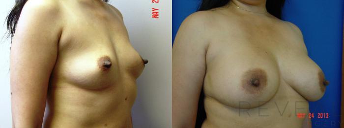Before & After Breast Augmentation Case 112 View #2 View in San Jose, CA