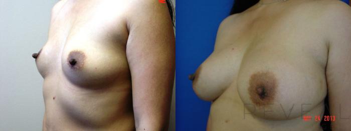 Before & After Breast Augmentation Case 112 View #3 View in San Jose, CA