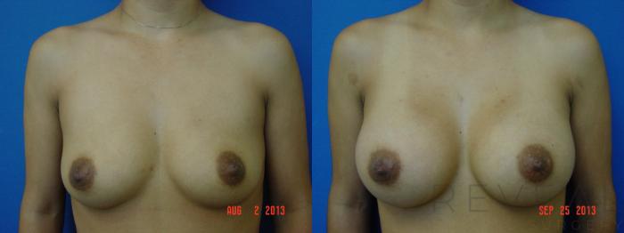 Before & After Breast Augmentation Case 113 View #1 View in San Jose, CA