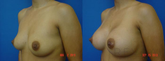 Before & After Breast Augmentation Case 113 View #2 View in San Jose, CA