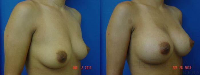 Before & After Breast Augmentation Case 113 View #3 View in San Jose, CA