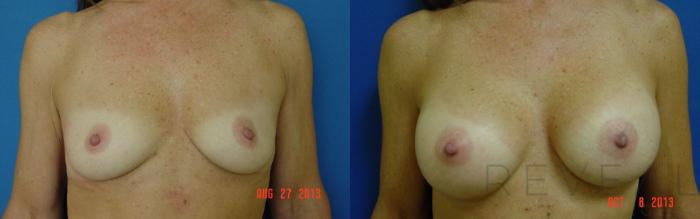 Before & After Breast Augmentation Case 114 View #1 View in San Jose, CA