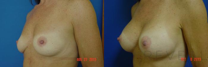 Before & After Breast Augmentation Case 114 View #2 View in San Jose, CA