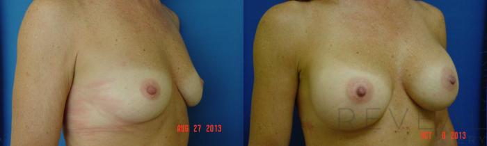 Before & After Breast Augmentation Case 114 View #3 View in San Jose, CA