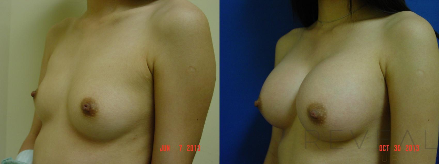 Before & After Breast Augmentation Case 117 View #1 View in San Jose, CA