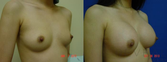 Before & After Breast Augmentation Case 117 View #2 View in San Jose, CA