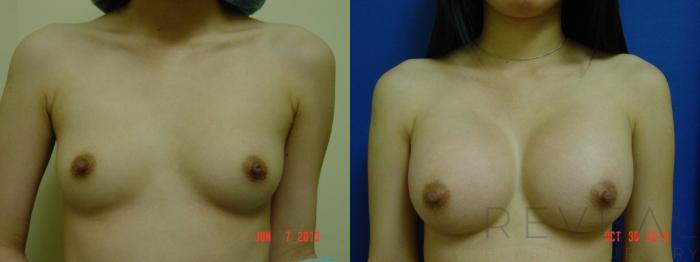 Before & After Breast Augmentation Case 117 View #3 View in San Jose, CA