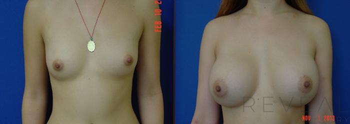 Before & After Breast Augmentation Case 119 View #1 View in San Jose, CA