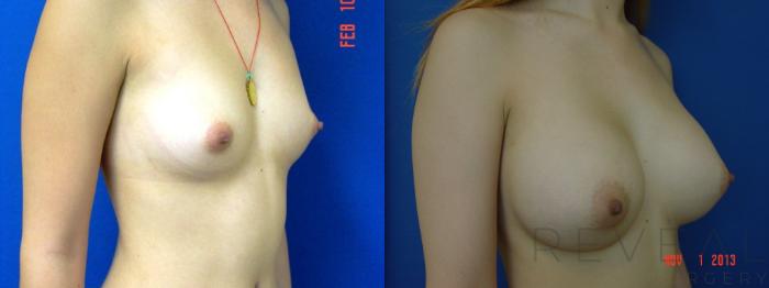 Before & After Breast Augmentation Case 119 View #2 View in San Jose, CA