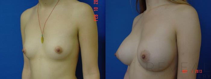 Before & After Breast Augmentation Case 119 View #3 View in San Jose, CA