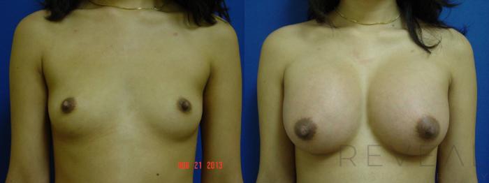 Before & After Breast Augmentation Case 121 View #1 View in San Jose, CA
