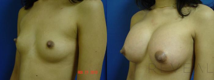 Before & After Breast Augmentation Case 121 View #3 View in San Jose, CA