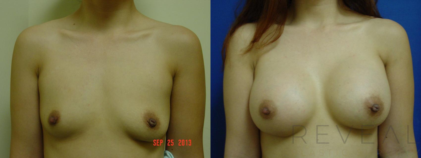 Before & After Breast Augmentation Case 122 View #1 View in San Jose, CA